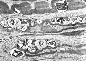 F,8y. | metachromatic leukodystrophy - n. suralis F,8y. | metachromatic leukodystrophy - n. suralis
